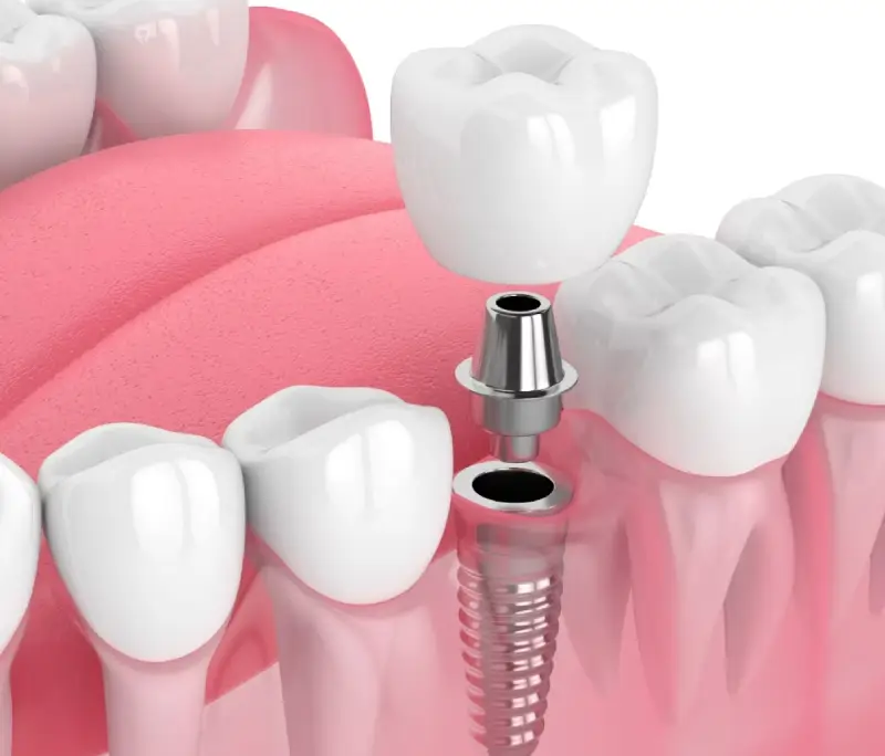 Giá trồng răng Implant 2025 bao nhiêu tiền?
